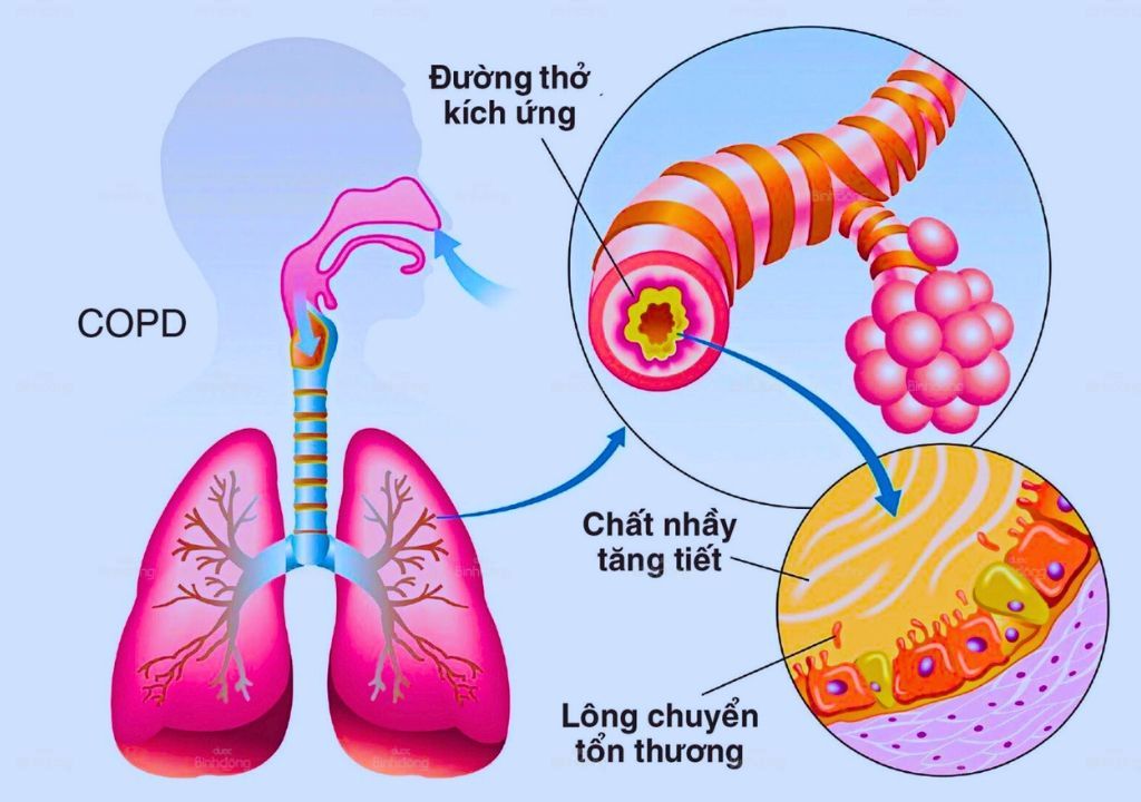 Copd-gay-ton-thuong-nghiem-trong-mo-phoi.jpg